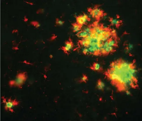  ??  ?? Les cellules microglial­es (en rouge) jouent un rôle dans l’éliminatio­n des plaques amyloïdes (en vert).