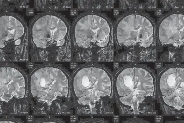  ?? SUTTHABURA­WONK/GETTY IMAGES ?? Prion diseases consist of a family of rare neurodegen­erative disorders caused by proteins that have folded abnormally.