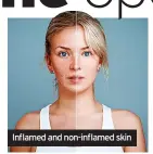  ?? ?? Inflamed and non-inflamed skin