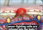  ?? ?? Cancer-fighting cells are
infused into the body