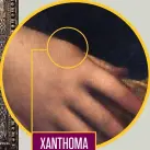  ??  ?? XANTHOMA