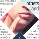  ??  ?? Cold sores are common