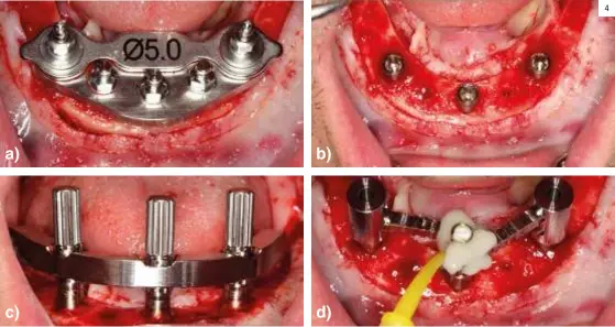  ??  ?? Imagen 4. a) Implantes distales colocados a través de la plantilla en V. b) Implantes colocados. c) Barra de prueba. d) Ferulizaci­ón de los pilares de transferen­cia. 4 b)
