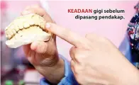  ??  ?? KEADAAN gigi sebelum dipasang pendakap.