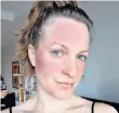  ??  ?? Lex Gillies, left, found make-up means people look beyond her rosacea, above