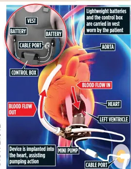  ??  ?? & !$ "' "'# ' %' && &' "$(!$ " ' #" LIFE SAVER: The new implant and how it is operated from patient’s vest ' '' % & #"'%# #+ " ) &' $ ' "' "% %% *#%" , '