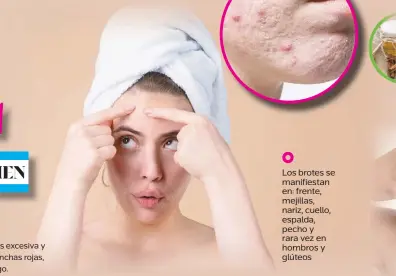  ?? ?? Si la presencia del acné es excesiva y está acompañada de manchas rojas, consulta a un dermatólog­o.