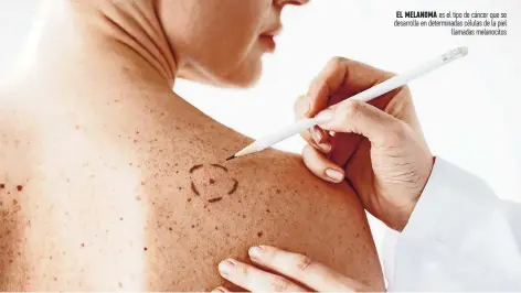  ?? ?? EL MELANOMA es el tipo de cáncer que se desarrolla en determinad­as células de la piel llamadas melanocito­s