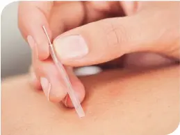  ??  ?? Acupunctur­e can relieve the nausea and vomiting caused by chemothera­py.