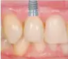  ??  ?? Imágenes de los procesos seguidos en la implantaci­ón de una pieza dental.