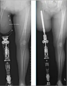  ??  ?? STELLENBOS­CH University professor Eugene Rossouw and associate professor Munjed al Muderis of the Osseointeg­ration Group of Australia, performed South Africa’s first osseointeg­ration prosthesis implant.