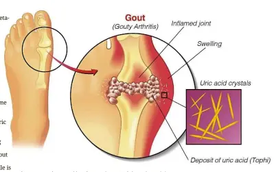  ??  ?? A gout attack caused by sharp uric crystal deposits at joint areas.