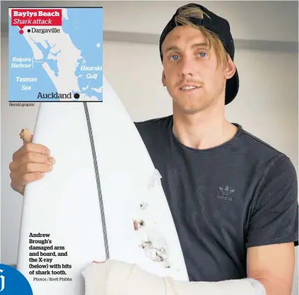  ?? Photos / Brett Phibbs ?? Andrew Brough’s damaged arm and board, and the X-ray (below) with bits of shark tooth.