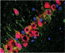  ??  ?? Microscopi­e de neurones marqués avec un anticorps révélant l’expression de l’enzyme CYP46A1 qui lutte contre le cholestéro­l.