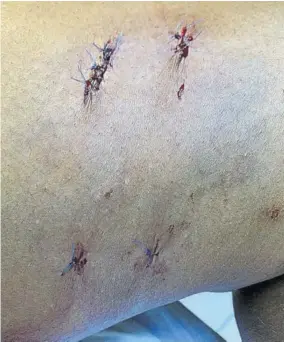  ??  ?? Wounds on the leg of a woman who was attacked by dogs outside the Green Bay Range in Portmore on November 17. The pack of five dogs bit her on both legs.