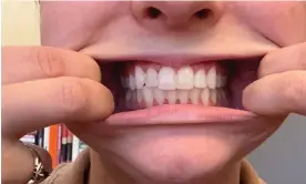  ?? Rebekka Reynolds ?? Rebekka Reynolds shows her teeth two months into treatment by SmileDirec­tClub. Photograph: