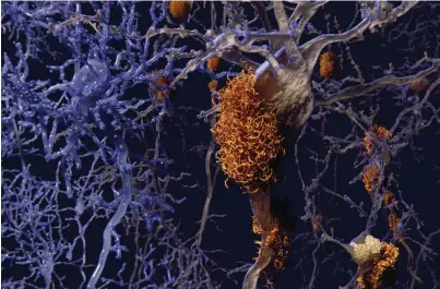  ??  ?? BELOW Characteri­stic protein ‘plaques’, visualised here in orange, can be seen in an Alzheimer’s brain