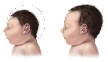  ??  ?? Baby with Microcepha­ly
Baby with Typical Head Size
WHO announced that a recent cluster of neonatal malformati­ons is likely linked to the presence of Zika