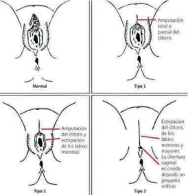  ??  ?? Ablación
Diferentes tipos de mutilación genital femenina.