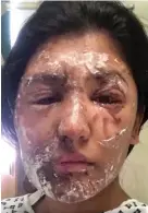  ??  ?? Skin grafts: Resham Khan