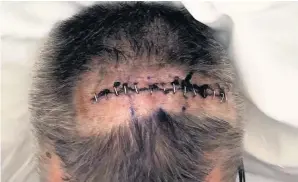  ??  ?? ■ Alan Purvis’s scar after his operation to remove most of the brain tumour