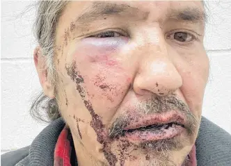  ?? COURTESY OF ALLAN ADAM VIA REUTERS ?? Chief Allan Adam of Athabasca Chipeywan First Nation displays his wounds that he says were caused by Royal Canadian Mounted Police (RCMP) officers of the Wood Buffalo detachment in an incident in Fort Mcmurray, Alberta, Canada March 10, 2020. Picture taken March 10, 2020.