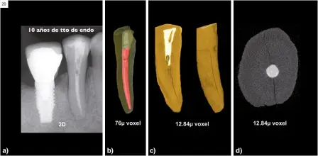  ?? ?? Figura 20.
Patología perirradic­ular del segundo premolar inferior derecho. a) Radiografí­a periapical. Imagen radiolúcid­a perirradic­ular. Tratamient­o de conductos realizado hace diez años. Diagnóstic­o: fractura radicular vertical; b) Imagen CBCT 76 μ no muestra la línea de fractura; c) Imagen μCT 12,84 μ vóxel muestra la línea de fractura; d) Imagen μCT 12,84 μ vóxel muestra la línea de fractura.