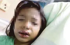  ?? PIC BY MOHD KHAIRUL HELMY MOHD DIN ?? The 7-year-old victim at Kuala Lumpur Hospital’s Paediatric Unit yesterday.