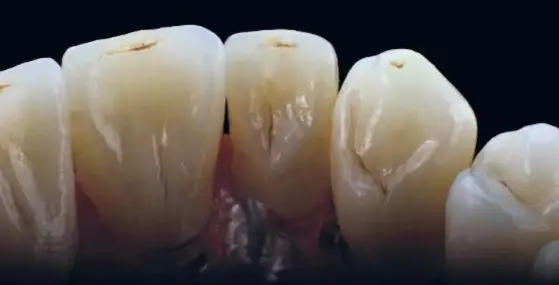  ??  ?? Estructura dental diseñada y fresada con biopolímer­o dopada de grafeno.