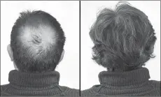  ?? ?? Breakthrou­gh research proves this discovery helps fill-in bald spots, re-nournishes thinning hair, and leads to noticeable growth in as little as 30 days.