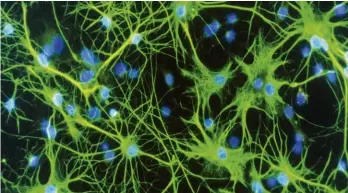  ??  ?? The brain’s star-shaped auxiliary cells, the astrocytes (in green) can in rare cases develop into cancer cells.