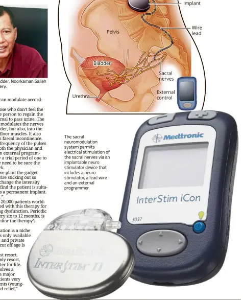  ??  ?? The sacral neuromodul­ation system permits electrical stimulatio­n of the sacral nerves via an implantabl­e neuro stimulator device that includes a neuro stimulator, a lead wire and an external programmer.