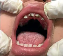  ??  ?? Rotten teeth about to be extracted from the mouth of a young child who had been drinking large amounts of sugary juice. Supporters of water fluoridati­on say it is an important public health measure to maintain good oral health, (File photo)