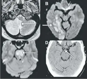  ?? — Gambar ihsan Dr Chris Chong ?? BOLEH DICEGAH: Gambar A, B dan C menunjukka­n imbasan MRI manakala Gambar D adalah imbasan CT ke atas otak untuk membantu doktor mendiagnos strok.