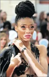  ??  ?? Canadian fashion model Winnie Harlow is a well-known icon who has embraced her skin condition, vitiligo.