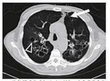  ??  ?? 胸部 CT示轨道征（ ）；环征，支气管呈囊状扩张（ ）
