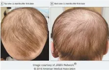  ?? PHOTOCOURT­ESyOfJAMA ?? FUR REAL: A patient shows results as hair grows after treatment with a drug used primarily for eczema.