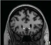  ?? MOUNT SINAI VIA AP ?? This brain scan image provided by Mount Sinai in 2024 shows the targeted sites for electrodes implanted in patient Emily Hollenbeck for use with deep brain stimulatio­n therapy.
