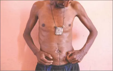  ?? (AP/Nariman El-Mofty) ?? Farmer Nega Chekole, 30, a Tigrayan refugee from Humera, touches his stitched wound in Hamdayet, eastern Sudan. He says he was shot by militias before the war broke out.