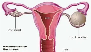  ??  ?? SISTA terbentuk di bahagian kilang telur wanita.