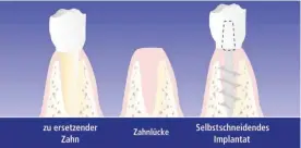  ??  ?? Diese Implantati­onsmethode ist ideal für stark geschädigt­e Kiefer, bei denen viele oder alle Zähne ersetzt werden müssen.