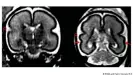  ?? ?? Izquierda: Cerebro fetal tras la exposición al alcohol intrauteri­no en un feto de entre 25 y 29 semanas de gestación. Obsérvese la corteza lisa en los lóbulos frontopari­etal y temporal. Derecha: Cerebro de un caso de control sano emparejado en un feto de entre 25 y 28 semanas de gestación. El surco temporal superior ya está formado bilateralm­ente (flechas rojas) y aparece más profundo en el hemisferio derecho que en el izquierdo.