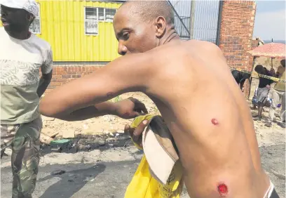  ?? Picture: Silver Sibiya ?? UNPROVOKED. Lethu Ntshaba has wounds from rubber bullets on his back and hand.