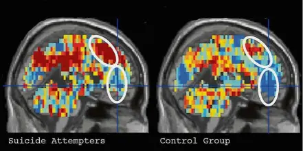  ?? — TNS ?? A brain scan might be able to predict who might attempt suicide.