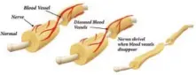  ??  ?? Figure 2: When these very small blood vessels become diseased they begin to shrivel up and the nerves begin to degenerate.