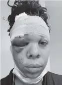  ?? LATOYA RATLIEFF ?? Police shot LaToya Ratlieff with a rubber bullet at a Fort Lauderdale protest on May 31, injuring her eye socket.