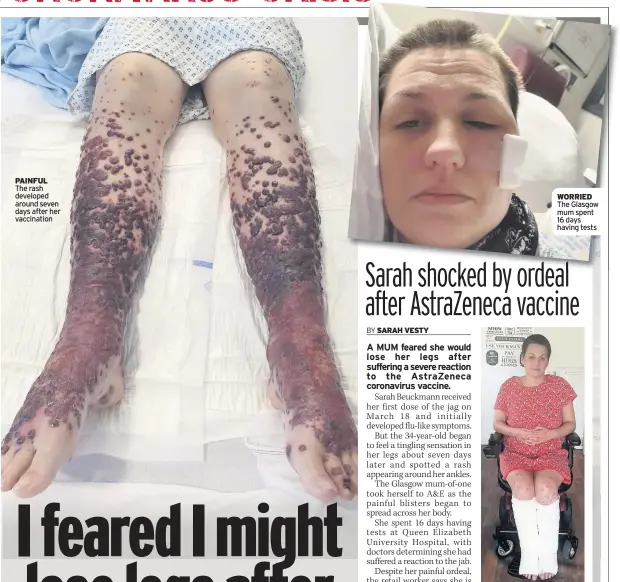  ??  ?? PAINFUL The rash developed around seven days after her vaccinatio­n
WORRIED The Glasgow mum spent 16 days having tests
HOME Sarah Beuckmann