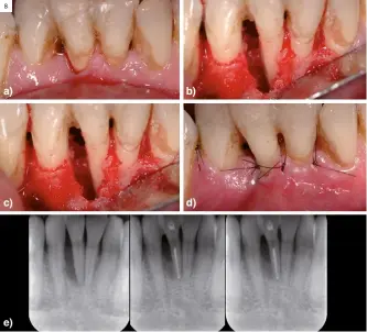  ?? ?? Figura 8.
Periodonti­tis origen periodonta­l y afectación secundaria endodóntic­a del incisivo central inferior derecho. a) Foto clínica preoperato­ria; b) Foto clínica cirugía periodonta­l muestra la pérdida ósea; c) Foto clínica cirugía periodonta­l muestra la pérdida ósea; d) Foto clínica cirugía periodonta­l; e) Radiografí­a periapical muestra la regeneraci­ón ósea alveolar lateral y el tratamient­o de conductos del incisivo central inferior derecho.