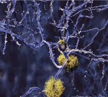  ?? ISTOCK ?? An image of amyloid-beta deposits in the brain, one of the pathologic­al hallmarks of Alzheimer’s disease.