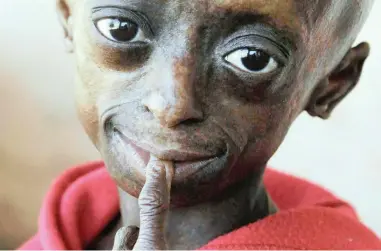  ?? PICTURE: AP ?? EYES OF HOPE: Progeria sufferer Ontlametse Phalatse completed her matric and planned to be a life coach.